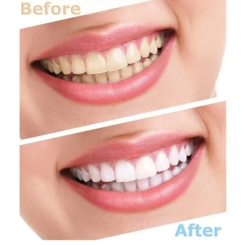 Professional Teeth Whitening Kit with Peroxide Gel and LED Light